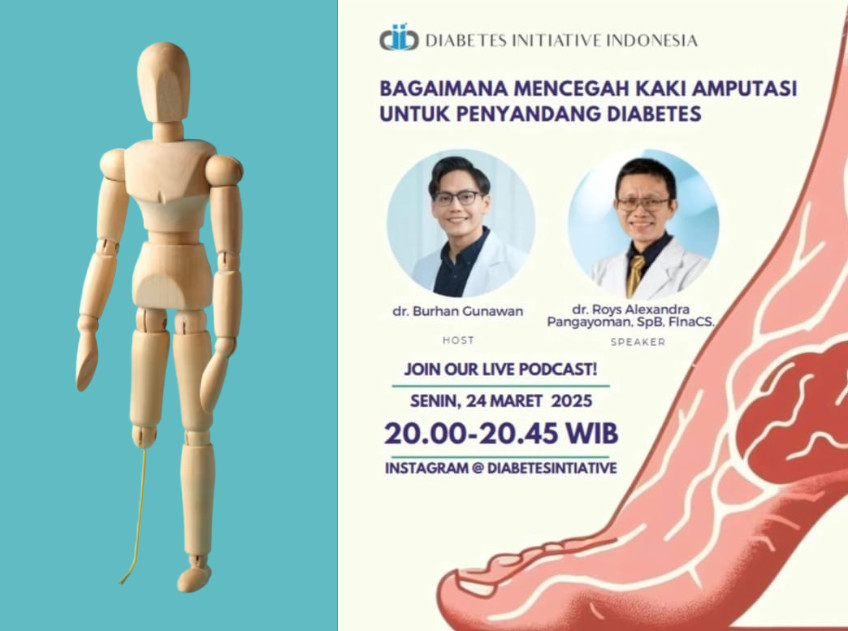 Bagaimana Mencegah Kaki Amputasi Untuk Penyandang Diabetes